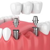 An implant bridge uses dental implants placed in the patient's jawbone as a base. The restorations are the visible portion on the top and replace the teeth. These can preserve the nearby teeth and preserve the jawbone. Plus, the implant bridges can maintain the shape of the patient's smile.